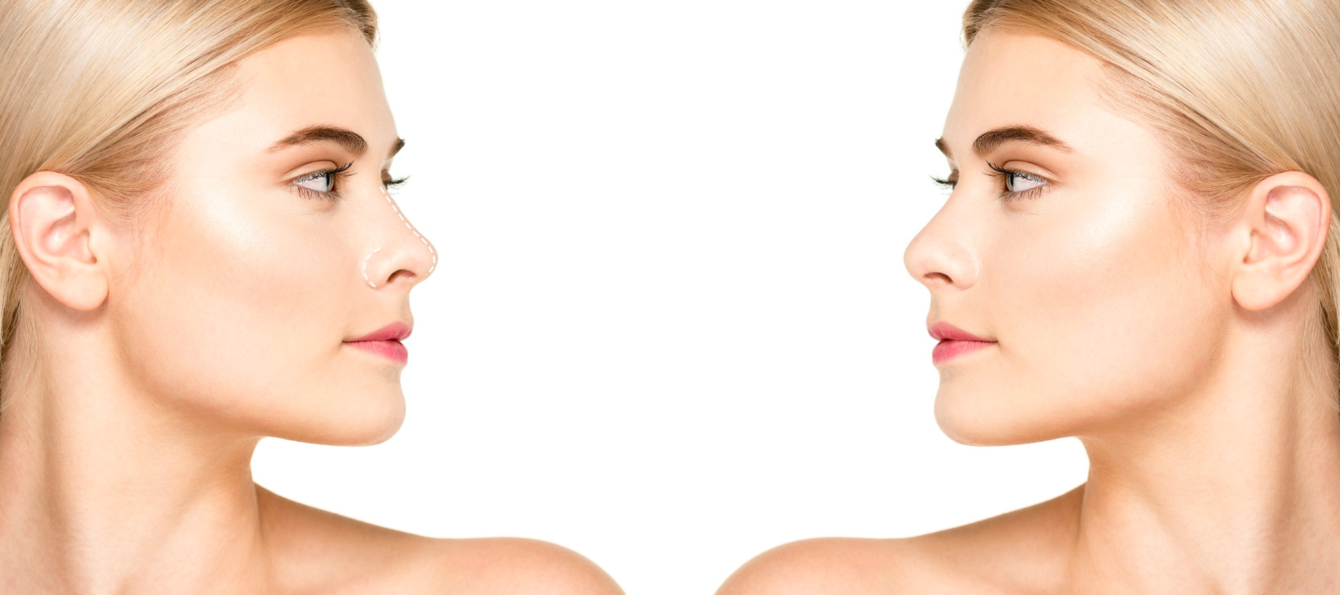 Rhinoplasty concept with woman model